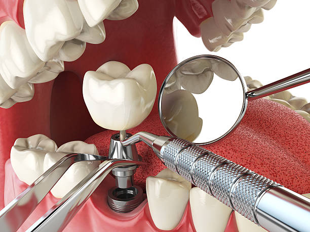 Best Urgent Care for Lost Fillings or Crowns in New Pek, IN